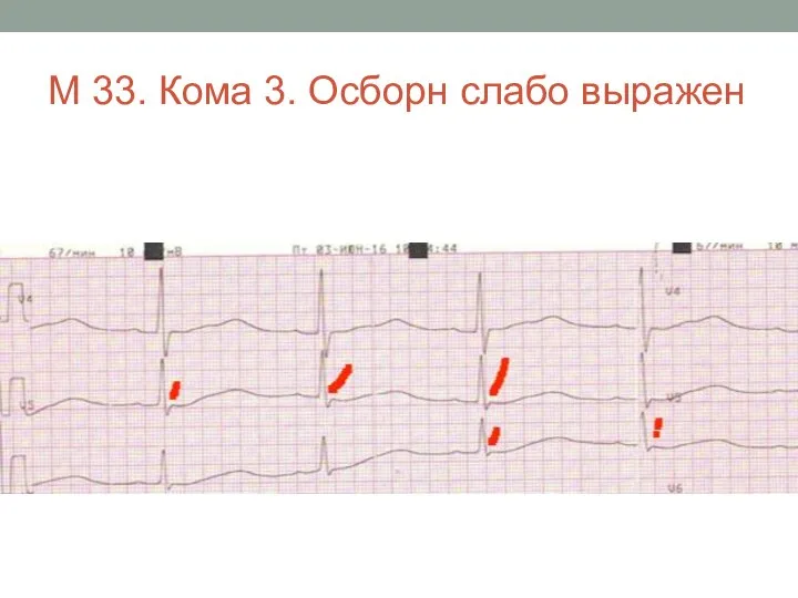 М 33. Кома 3. Осборн слабо выражен