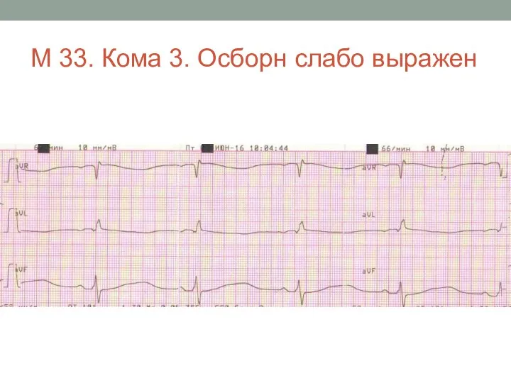 М 33. Кома 3. Осборн слабо выражен