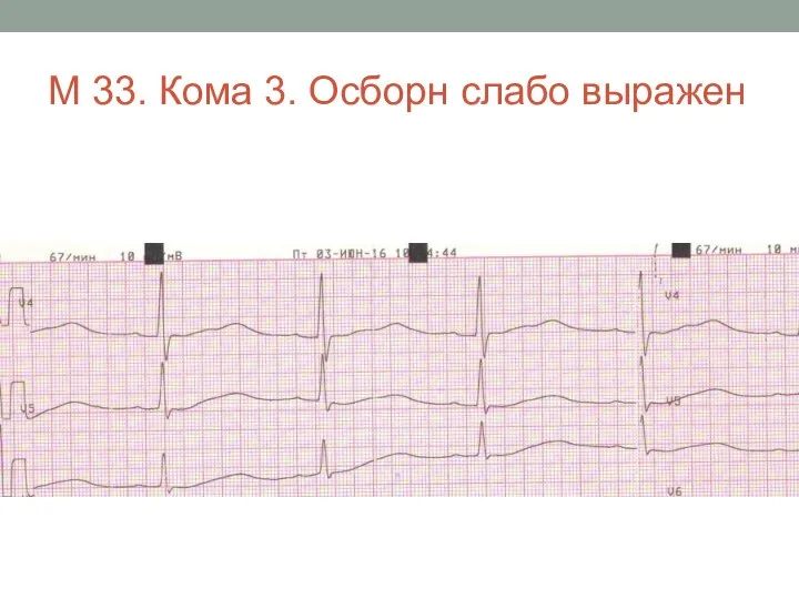 М 33. Кома 3. Осборн слабо выражен