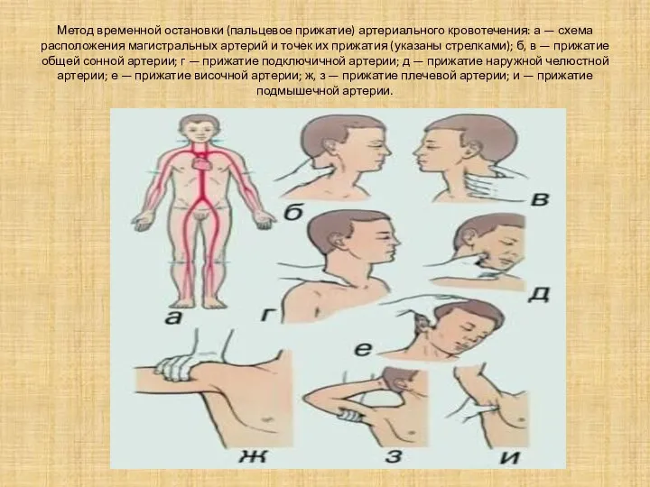 Метод временной остановки (пальцевое прижатие) артериального кровотечения: а — схема расположения магистральных