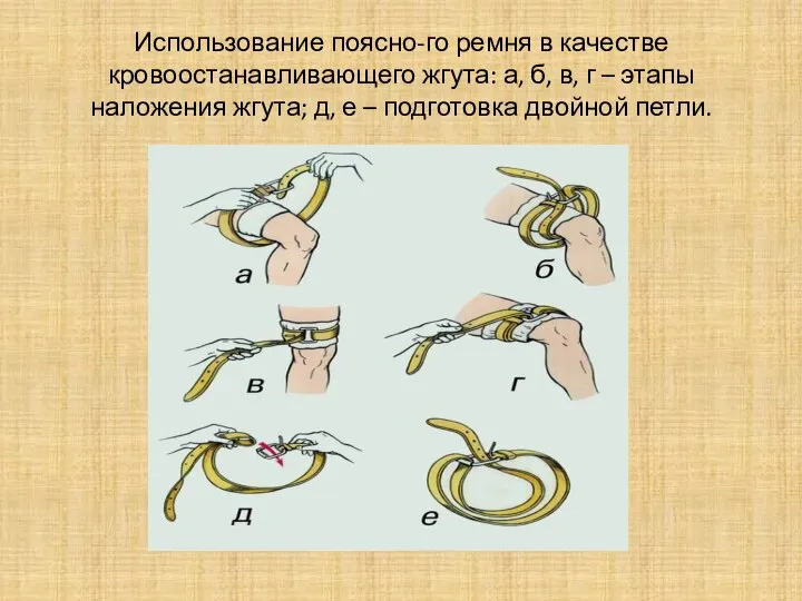 Использование поясно-го ремня в качестве кровоостанавливающего жгута: а, б, в, г –