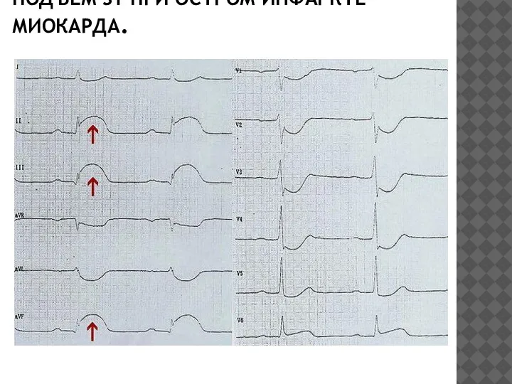 ПОДЪЕМ ST ПРИ ОСТРОМ ИНФАРКТЕ МИОКАРДА.