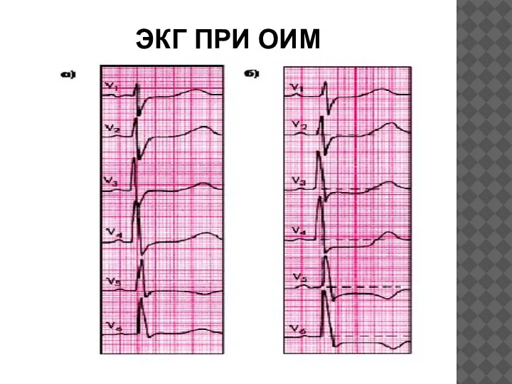 ЭКГ ПРИ ОИМ