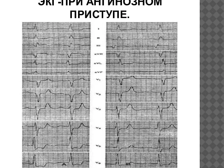 ЭКГ-ПРИ АНГИНОЗНОМ ПРИСТУПЕ.