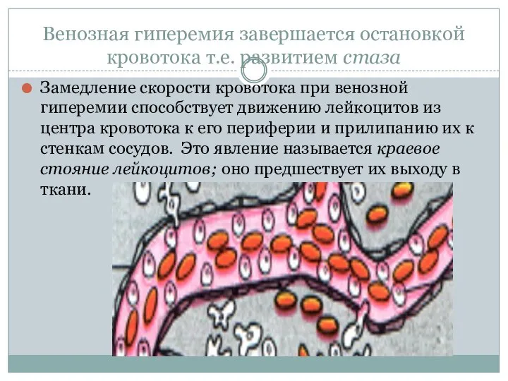 Венозная гиперемия завершается остановкой кровотока т.е. развитием стаза Замедление скорости кровотока при