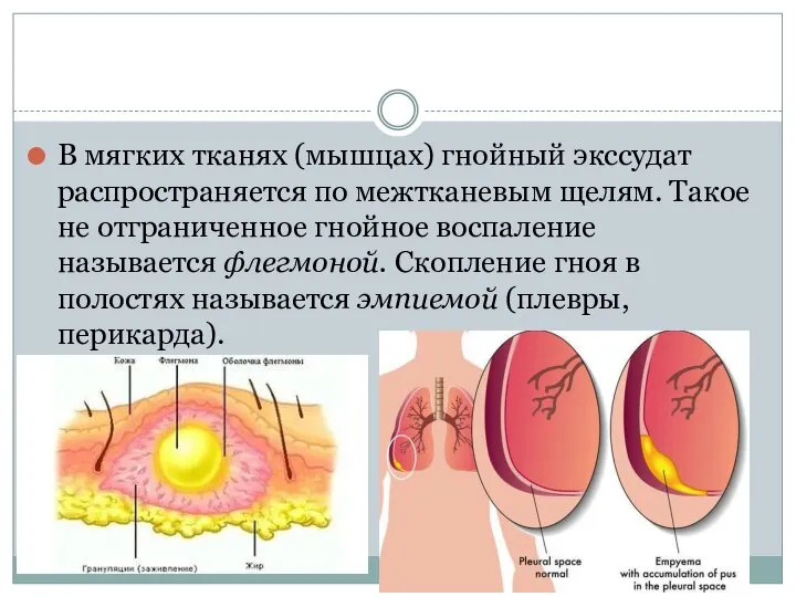 В мягких тканях (мышцах) гнойный экссудат распространяется по межтканевым щелям. Такое не