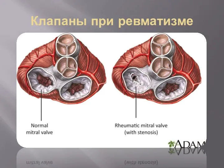 Клапаны при ревматизме