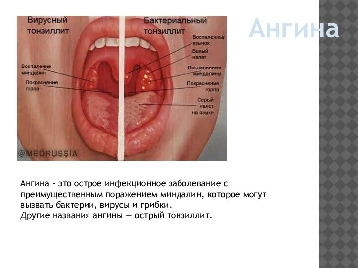 Ангина Ангина - это острое инфекционное заболевание с преимущественным поражением миндалин, которое
