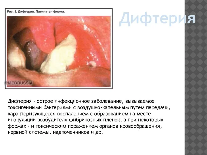 Дифтерия Дифтерия - острое инфекционное заболевание, вызываемое токсигенными бактериями с воздушно-капельным путем