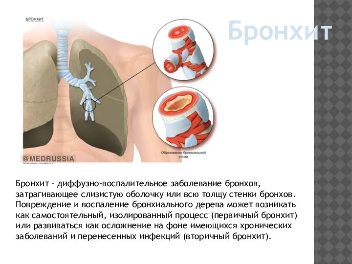 Бронхит Бронхит – диффузно-воспалительное заболевание бронхов, затрагивающее слизистую оболочку или всю толщу