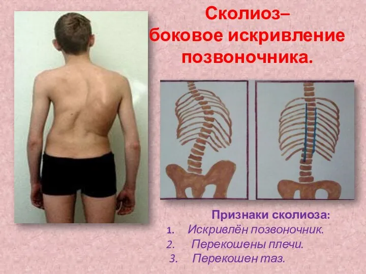 Сколиоз– боковое искривление позвоночника. Признаки сколиоза: Искривлён позвоночник. Перекошены плечи. 3. Перекошен таз.