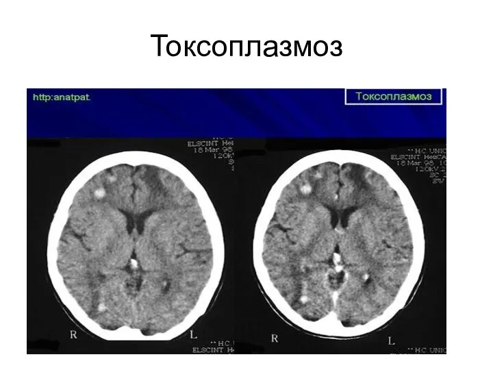 Токсоплазмоз