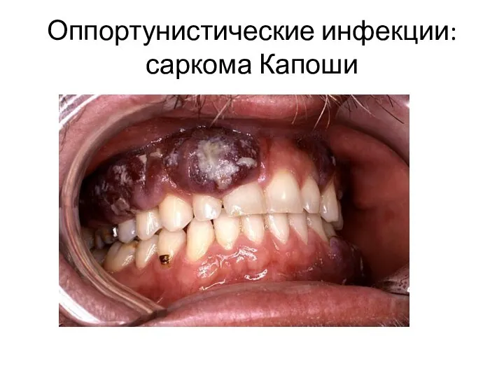 Оппортунистические инфекции: саркома Капоши