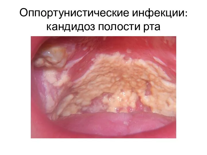 Оппортунистические инфекции: кандидоз полости рта