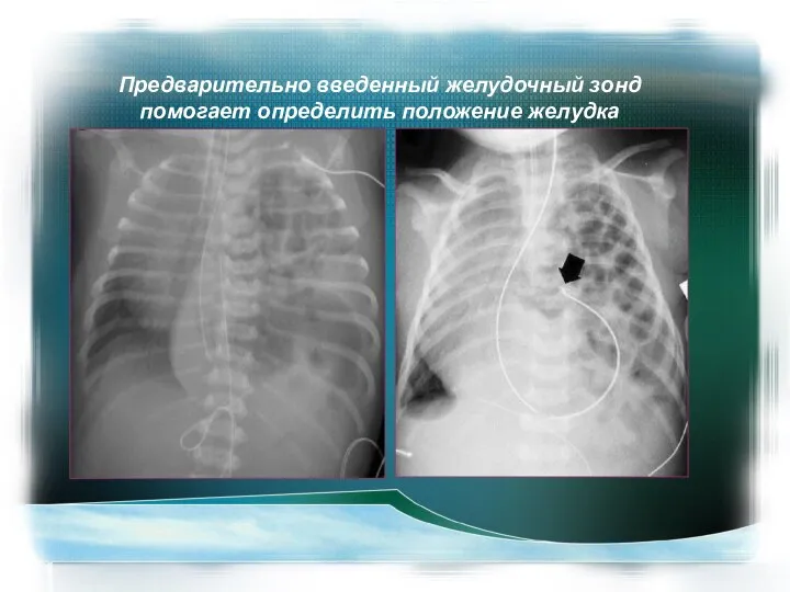 Предварительно введенный желудочный зонд помогает определить положение желудка