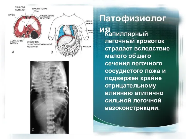 Патофизиология Капиллярный легочный кровоток страдает вследствие малого общего сечения легочного сосудистого ложа