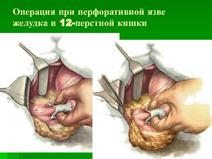 Операция при перфоративной язве желудка и 12-перстной кишки