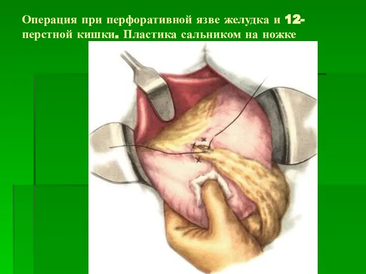 Операция при перфоративной язве желудка и 12-перстной кишки. Пластика сальником на ножке