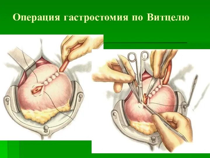 Операция гастростомия по Витцелю