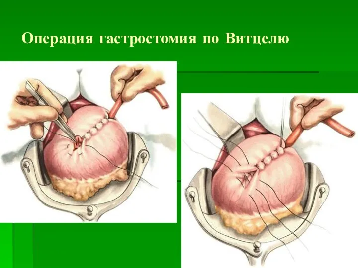 Операция гастростомия по Витцелю