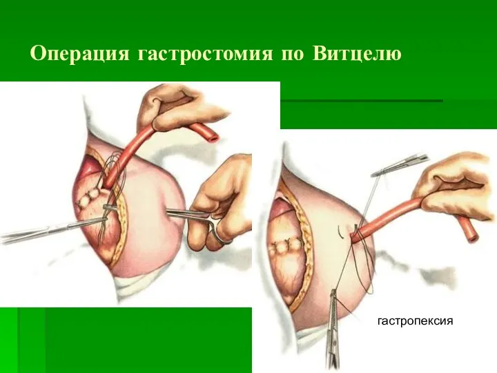 Операция гастростомия по Витцелю гастропексия