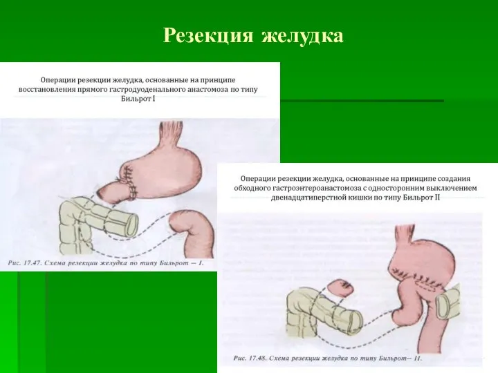 Резекция желудка