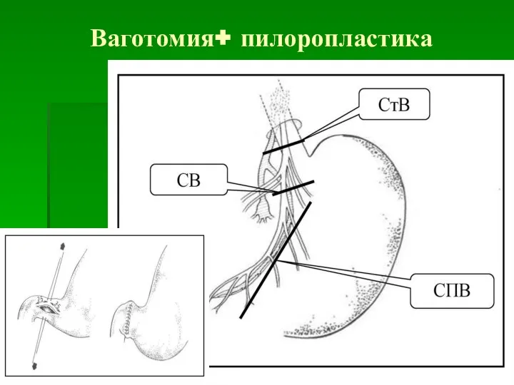 Ваготомия+ пилоропластика