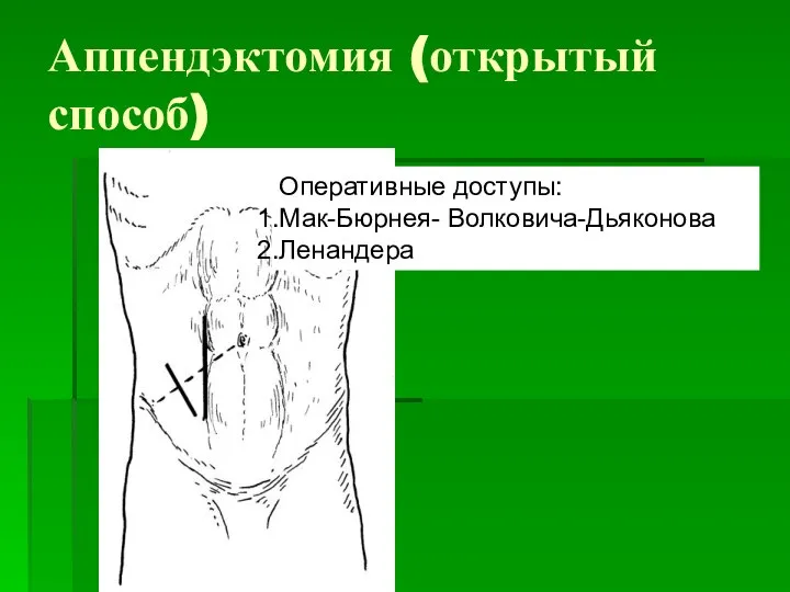 Аппендэктомия (открытый способ) Оперативные доступы: Мак-Бюрнея- Волковича-Дьяконова Ленандера