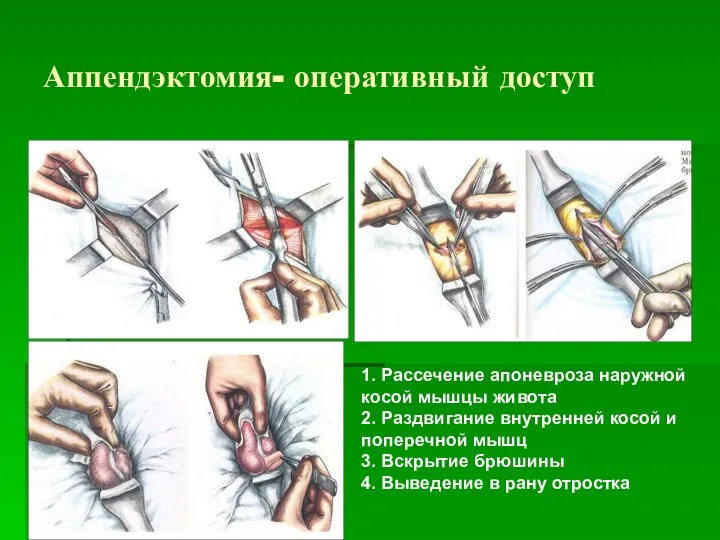 Аппендэктомия- оперативный доступ 1. Рассечение апоневроза наружной косой мышцы живота 2. Раздвигание