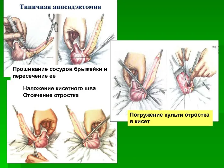 Прошивание сосудов брыжейки и пересечение её Наложение кисетного шва Отсечение отростка Погружение культи отростка в кисет