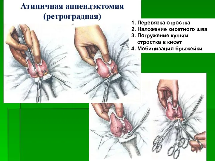 1. Перевязка отростка 2. Наложение кисетного шва 3. Погружение культи отростка в кисет 4. Мобилизация брыжейки