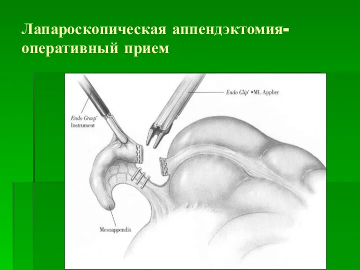 Лапароскопическая аппендэктомия- оперативный прием