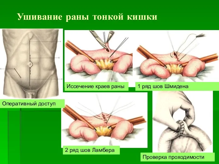 Ушивание раны тонкой кишки Иссечение краев раны Оперативный доступ 1 ряд шов