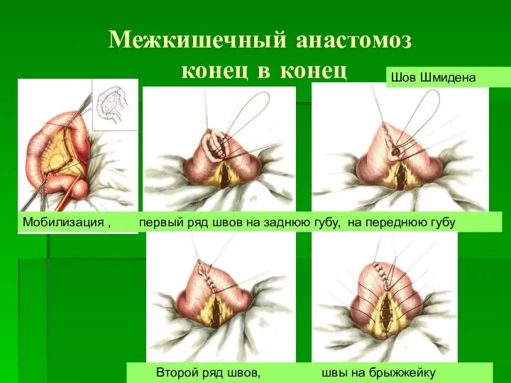 Межкишечный анастомоз конец в конец Мобилизация , первый ряд швов на заднюю