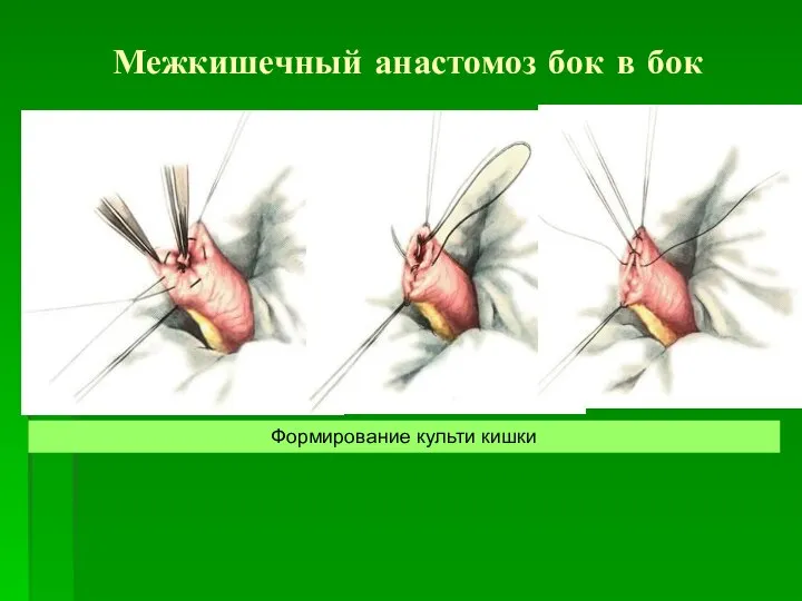 Межкишечный анастомоз бок в бок Формирование культи кишки