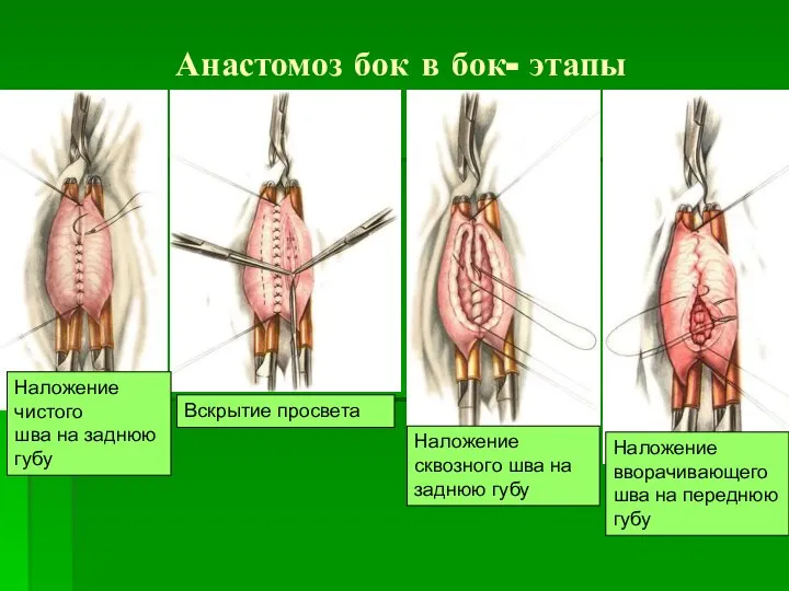 Анастомоз бок в бок- этапы Наложение чистого шва на заднюю губу Вскрытие