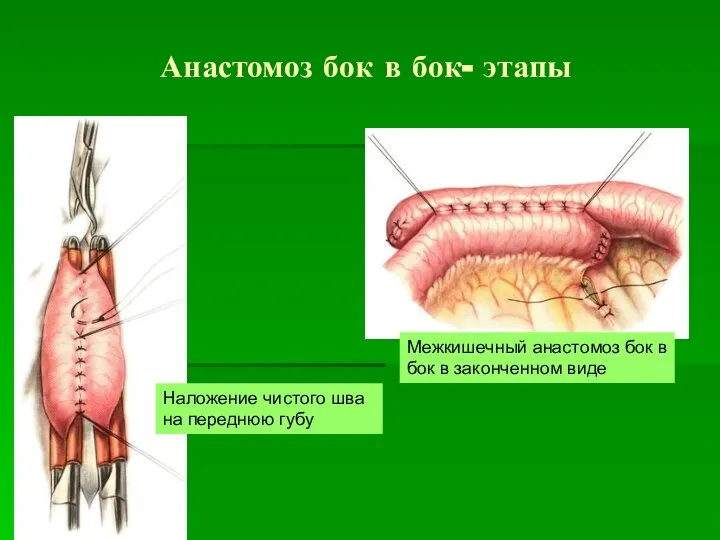 Анастомоз бок в бок- этапы Наложение чистого шва на переднюю губу Межкишечный