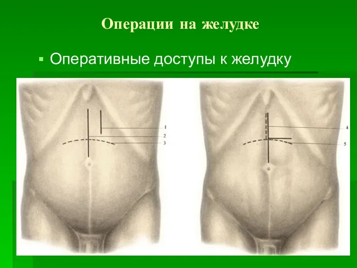 Операции на желудке Оперативные доступы к желудку