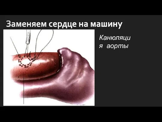 Канюляция аорты