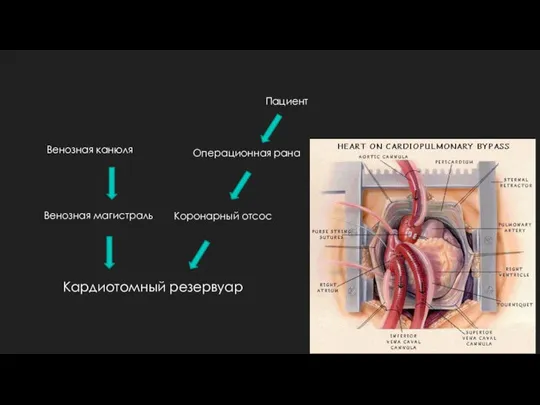 Кардиотомный резервуар Венозная канюля Венозная магистраль Операционная рана Коронарный отсос Пациент