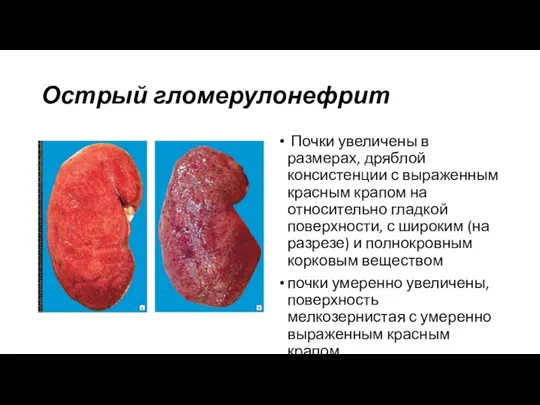 Острый гломерулонефрит Почки увеличены в размерах, дряблой консистенции с выраженным красным крапом