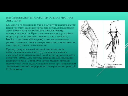 ВНУТРИВЕННАЯ И ВНУТРИАРТЕРИАЛЬНАЯ МЕСТНАЯ АНЕСТЕЗИЯ Больному в положении на спине с вытянутой