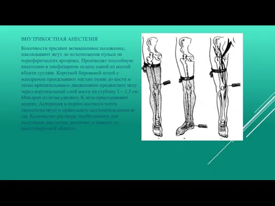 ВНУТРИКОСТНАЯ АНЕСТЕЗИЯ Конечности придают возвышенное положение, накладывают жгут до исчезновения пульса на