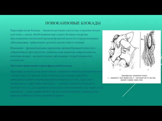 НОВОКАИНОВЫЕ БЛОКАДЫ Паранефральная блокада – введение раствора анестетика в околопочечную клетчатку с