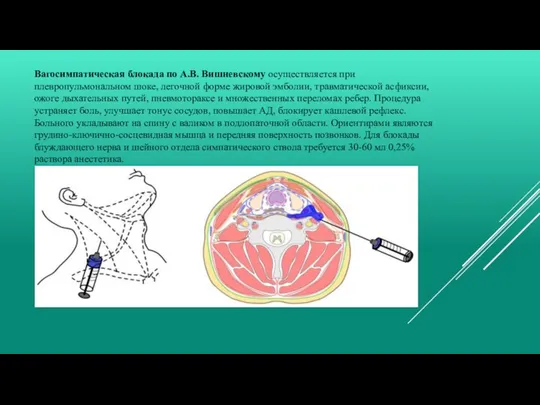 Вагосимпатическая блокада по А.В. Вишневскому осуществляется при плевропульмональном шоке, легочной форме жировой