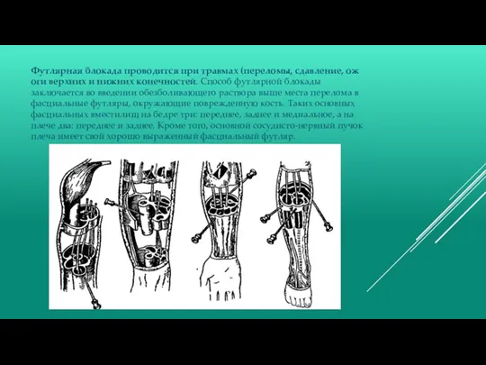 Футлярная блокада проводится при травмах (переломы, сдавление, ожоги верхних и нижних конечностей.