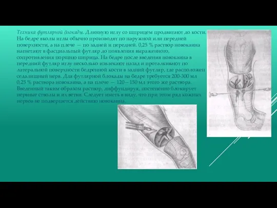 Техника футлярной блокады. Длинную иглу со шприцем продвигают до кости. На бедре