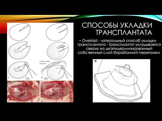 СПОСОБЫ УКЛАДКИ ТРАНСПЛАНТАТА Overlaid - латеральный способ укладки трансплантата - трансплантат укладывается