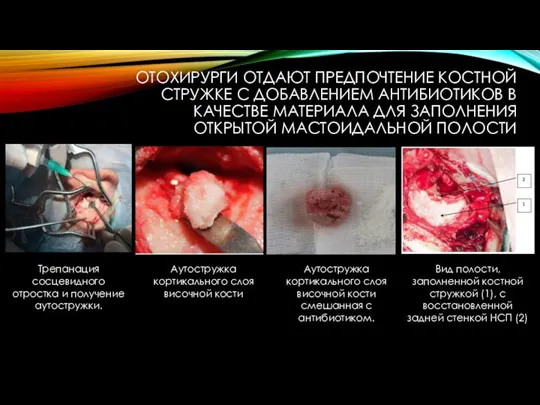 ОТОХИРУРГИ ОТДАЮТ ПРЕДПОЧТЕНИЕ КОСТНОЙ СТРУЖКЕ С ДОБАВЛЕНИЕМ АНТИБИОТИКОВ В КАЧЕСТВЕ МАТЕРИАЛА ДЛЯ