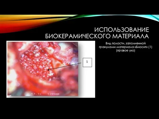 ИСПОЛЬЗОВАНИЕ БИОКЕРАМИЧЕСКОГО МАТЕРИАЛА Вид полости, заполненной гранулами материала «Биосит» (1) (правое ухо)